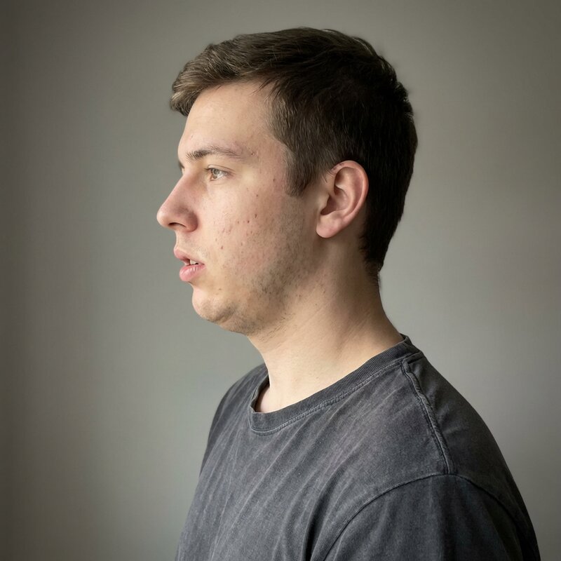 Avant — Respiration buccale, mâchoire reculée